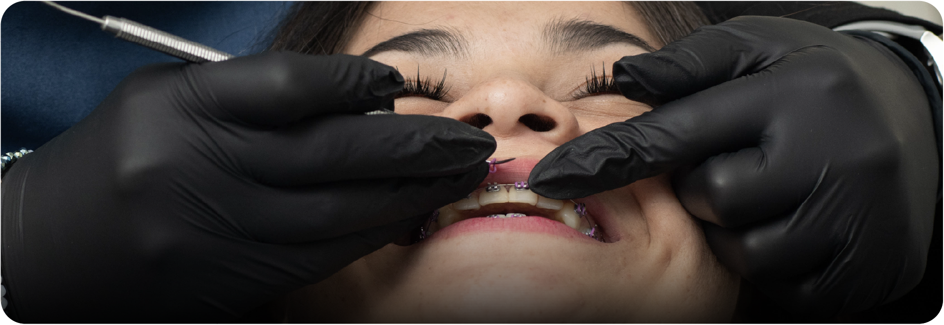 Ortodoncia estética